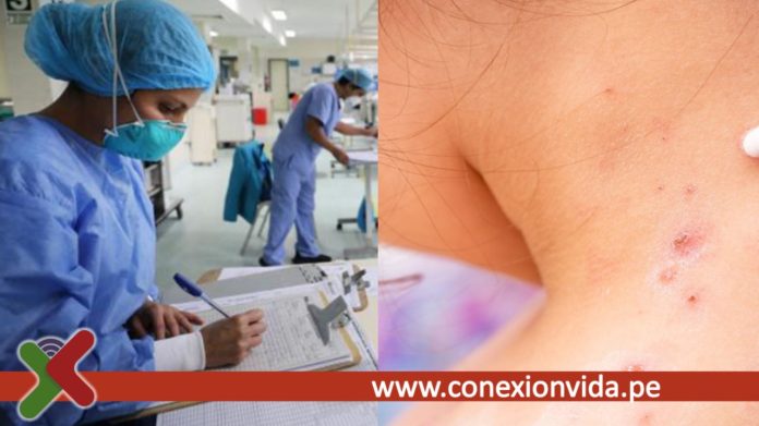 Reportan 161 casos de viruela del mono en La Libertad y Minsa pide a la población con VIH vacunarse