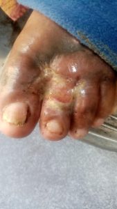 Pie lastimado de José Luis.